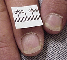 1567-2-psoriasis-neglepitting.jpg