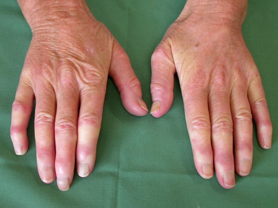 Ein Raynaud-Syndrom wird in 20–40 % der Fälle bei Dermatomyositis beobachtet.