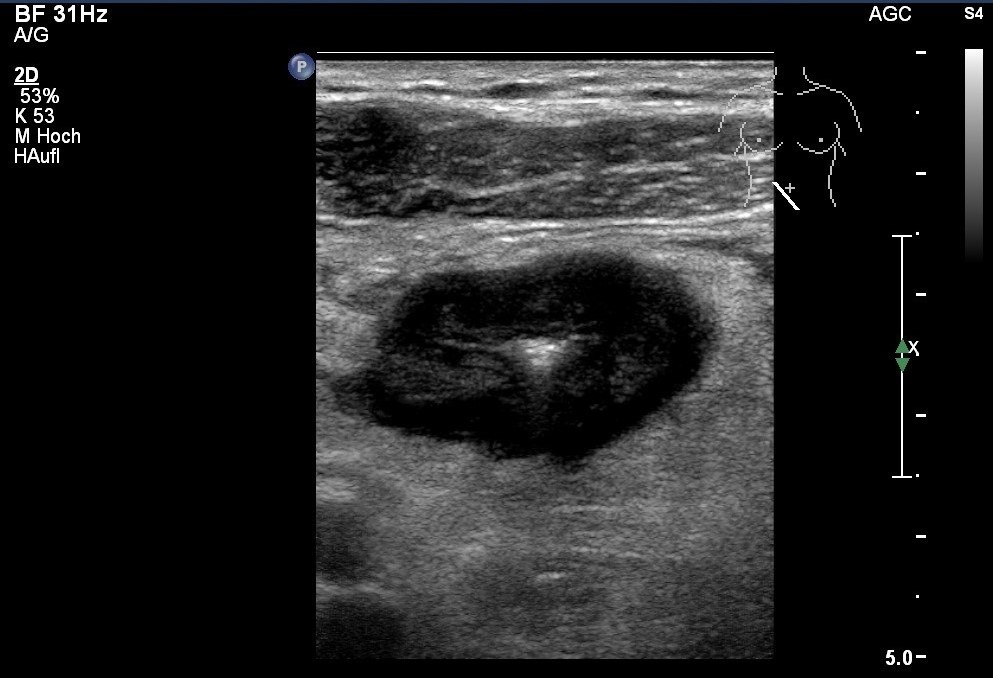 Sonografie: Echoarme Kokarde bei M. Crohn. Wandverdickung mit Lumeneinengung, echoreich verdicktes parakolisches Fettgewebe (mit freundlicher Genehmigung von sonographiebilder.de ©Albertinen-Diakoniewerk e.V., Hamburg).