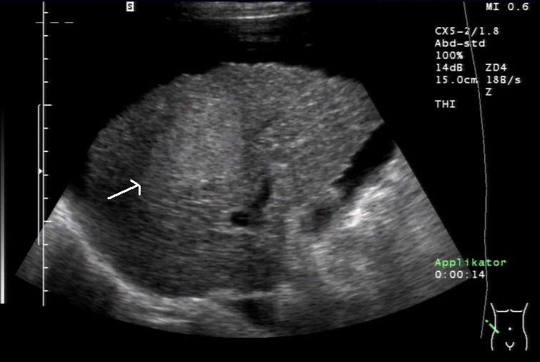 Sonografie: Leberzellkarzinom (HCC), solitär (mit freundlicher Genehmigung von sonographiebilder.de ©Albertinen-Diakoniewerk e. V., Hamburg).