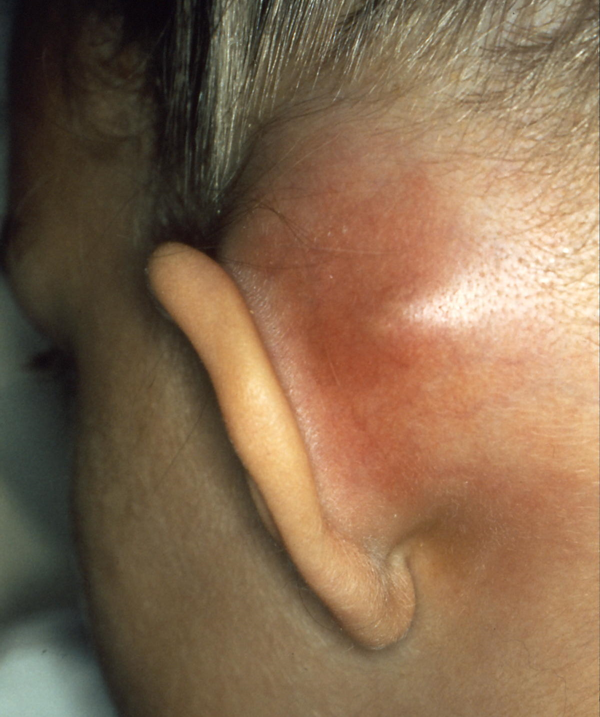 Mastoiditis1.jpg