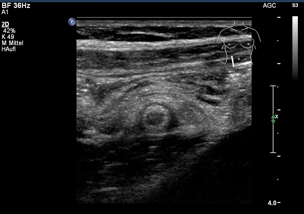 Sonografie: Appendizitis mit entzündlicher Umgebungsreaktion im Querschnitt (mit freundlicher Genehmigung von sonographiebilder.de ©Albertinen-Diakoniewerk e. V., Hamburg).