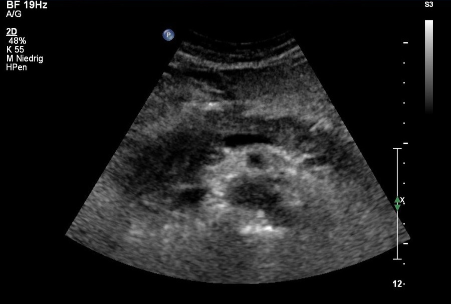 Sonografie: Ödematöse Pankreaskopfpankreatitis