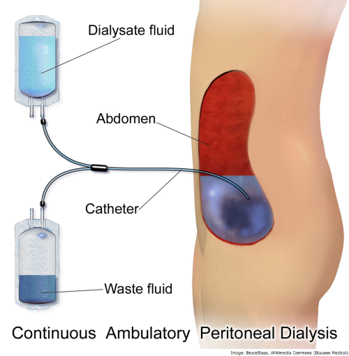 Peritoneal dialyse