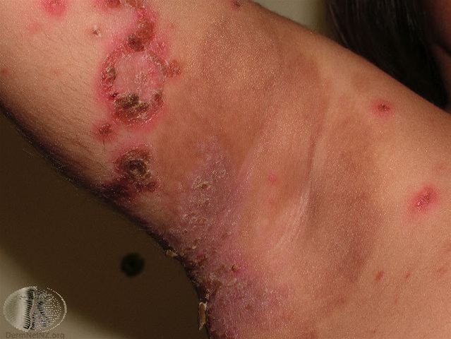 Eingetrocknete Impetigoblasen