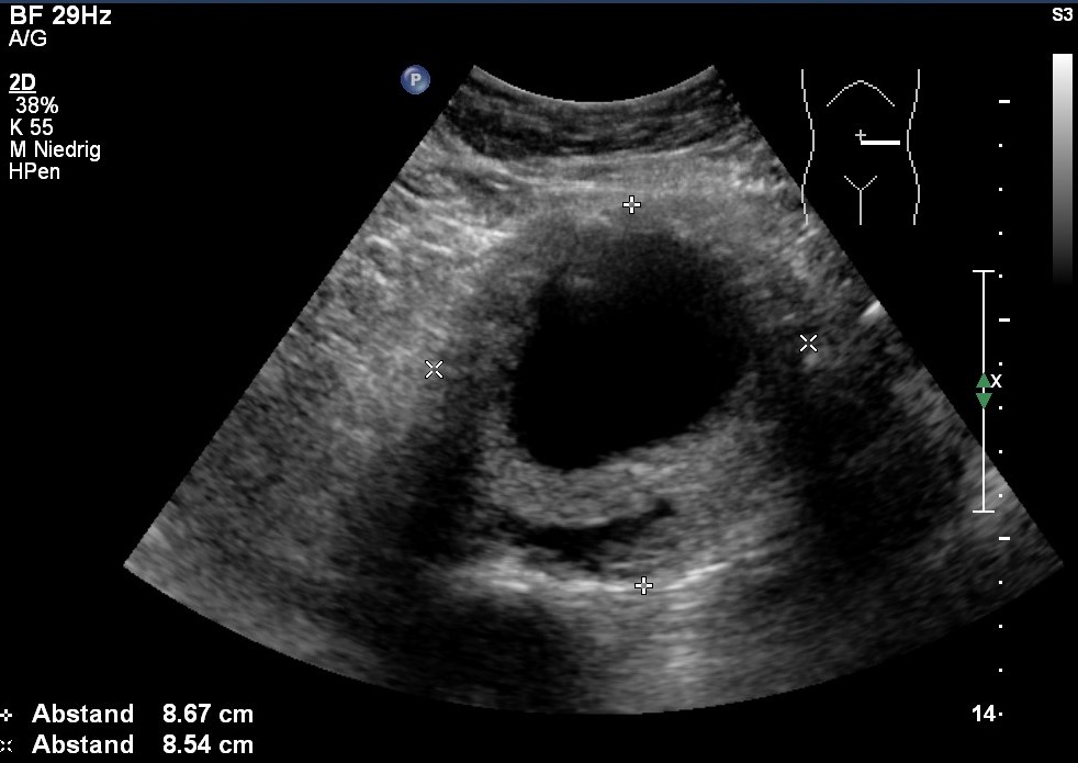 Sonografie: Bauchaortenaneurysma mit Dissektion