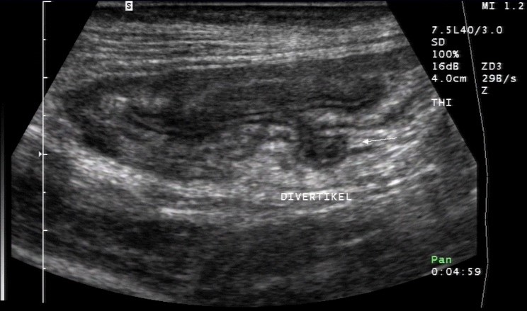 Sonografie: Kleines Divertikel