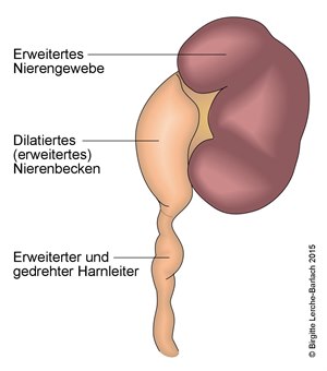 Hydronephrose.jpg