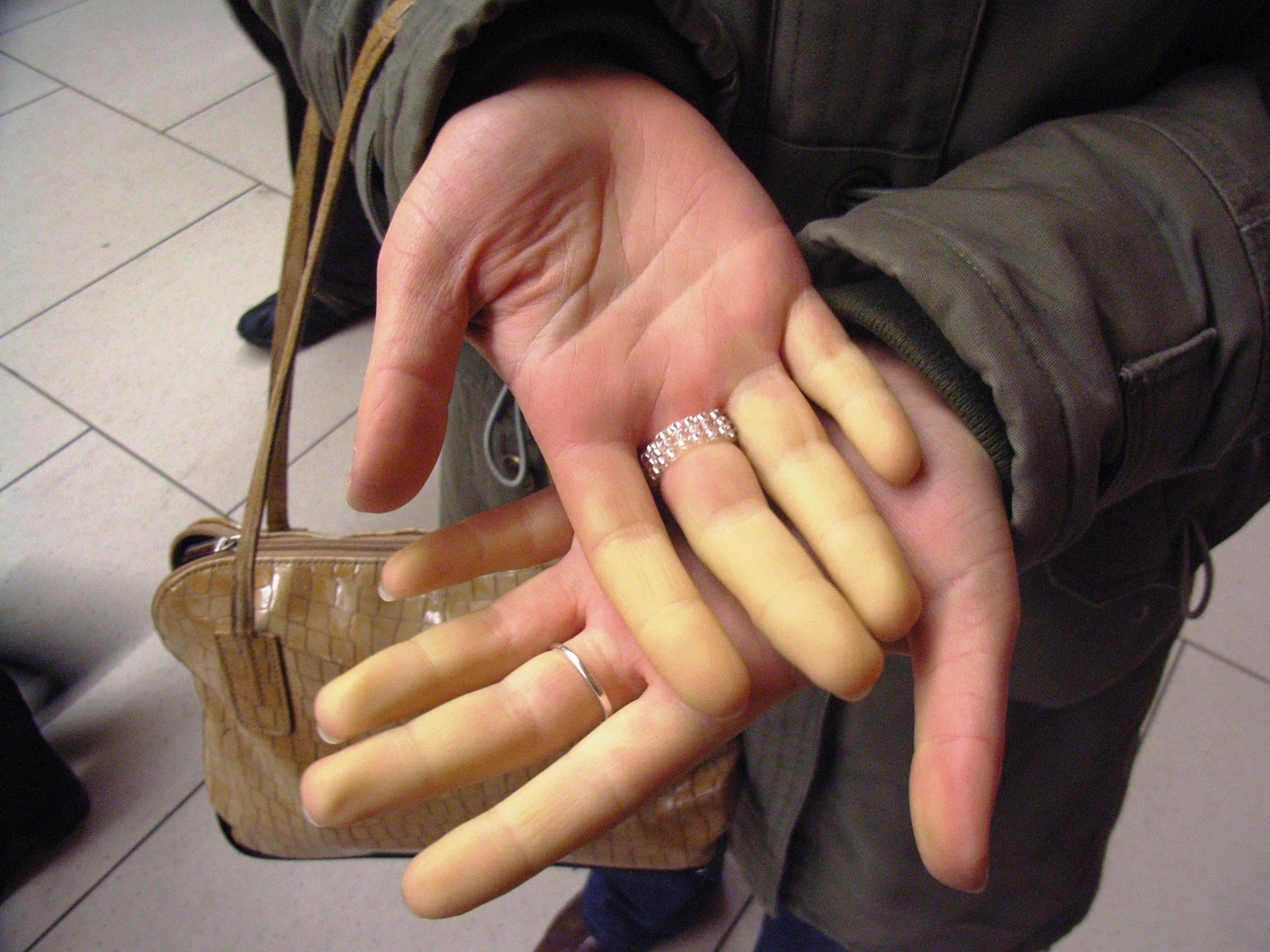 Raynaud (4).JPG