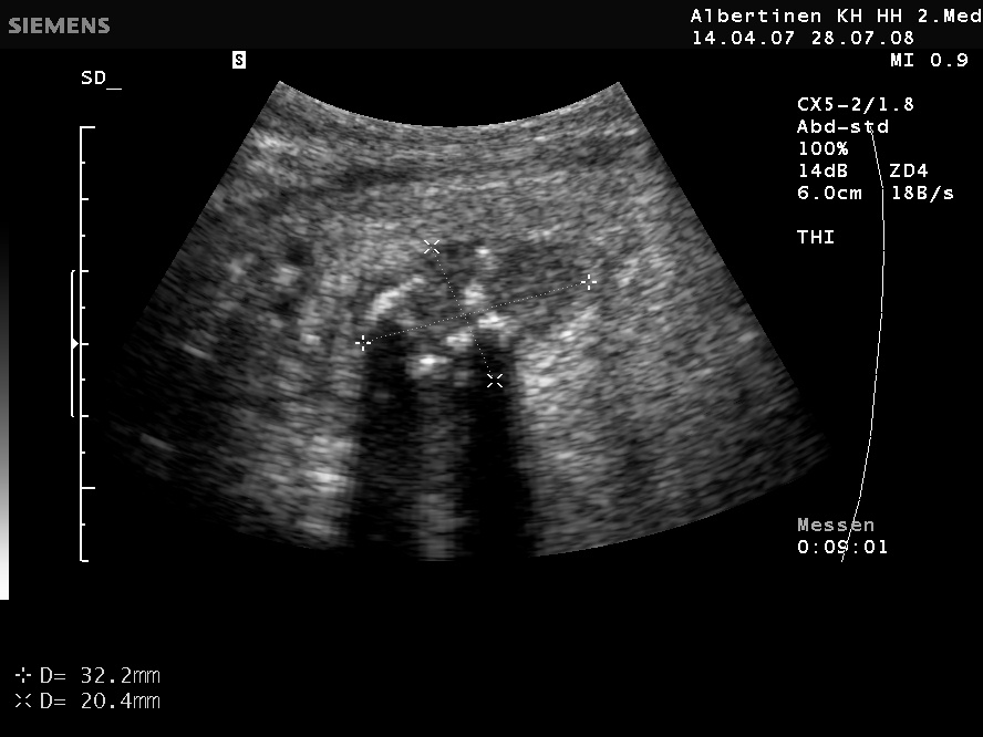 Schilddrüsenkarzinom in der Sonografie, echoarm, Mikrokalk, kein Halo (mit freundlicher Genehmigung von sonographiebilder.de ©Albertinen-Diakoniewerk e. V., Hamburg).