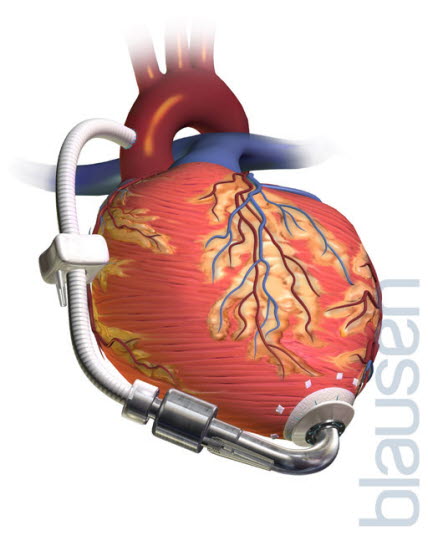 LVAD LeftVentricularAssistDevice - Implanterbar hjertepumpe