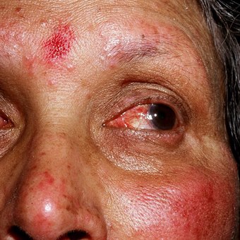 47407-2-okuler-rosacea.jpg 47407-2-okuler-rosacea.jpg
