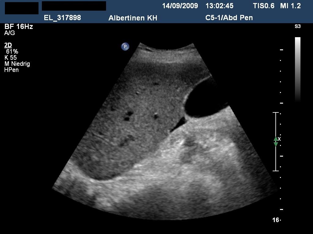 Sonografie: Gering ausgeprägter Aszites subhepatisch (mit freundlicher Genehmigung von sonographiebilder.de ©Albertinen-Diakoniewerk e.V., Hamburg).