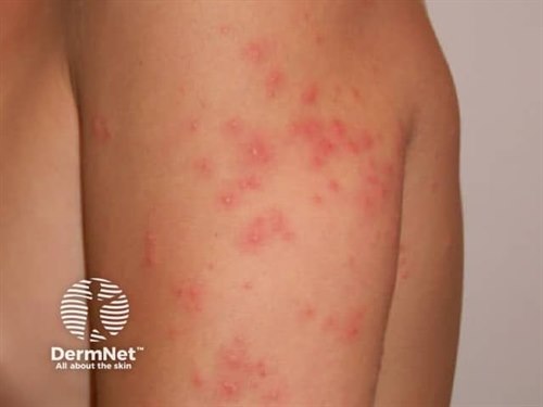 Fotoet viser utslett på overarm hos en person med svømmekløe