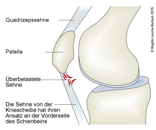 Patellaspitzensyndrom