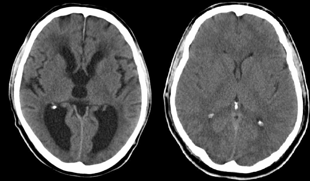 Hydrocephalus internus (links) und Normalbefund (rechts) in der CT