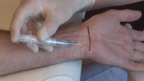 Insticksställe vid karpaltunnelsyndrom Insticksställe vid karpaltunnelsyndrom