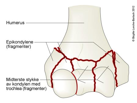 7327-2-fraktur-transkondyler-komminut-humerus2.jpg