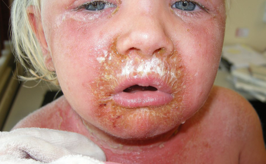 47332-2-staphylococcal-scalded-skin-syndrome.jpg