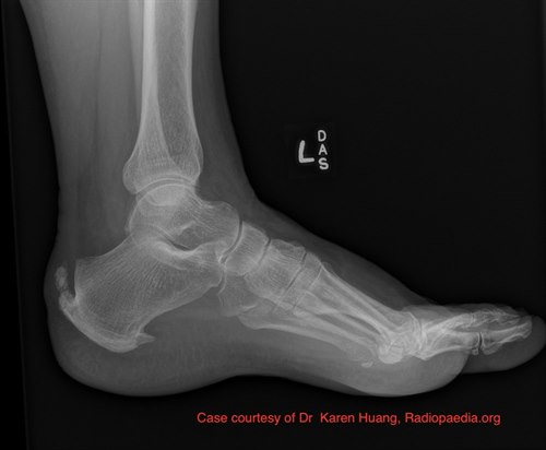 Haglund deformity.jpg