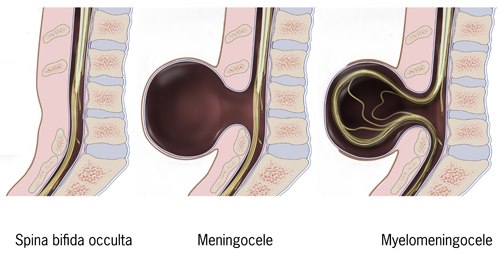 Spina bifida, fra CDC gov.jpg